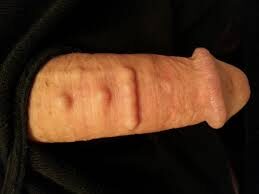 Pasang Tasbih & Tindik Alat Vital