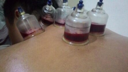 Bekam Pijat Gurah Panggilan Cimahi Dan Bandung